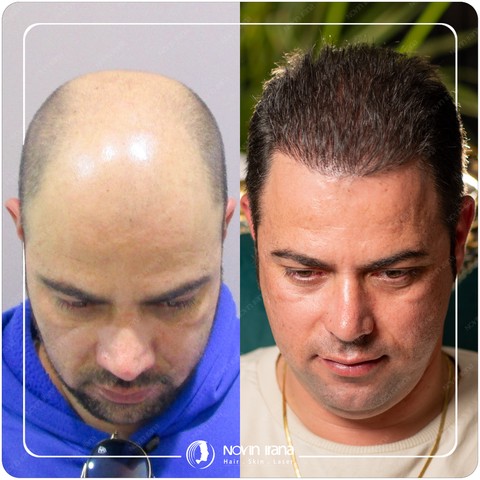 صفحه فروش کاشت مو در کلینیک نوین ایرانا